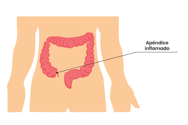 apendicitis aguda sintomas