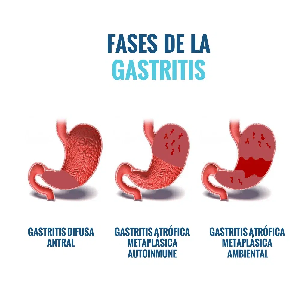 gastritis-cronica-fases