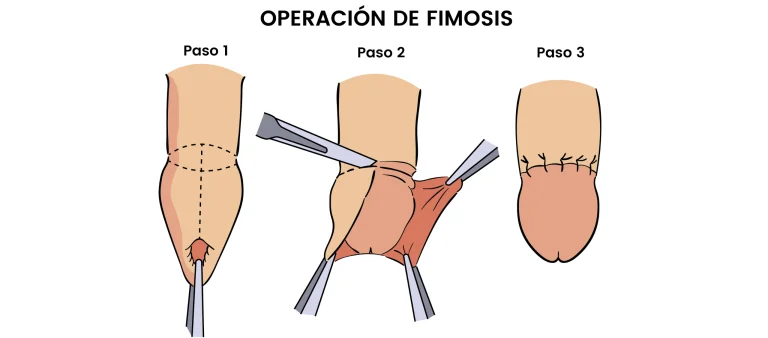 operacion-fimosis-madrid