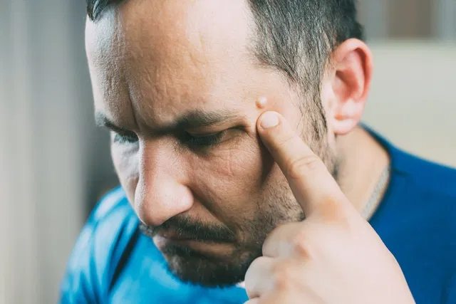 diferencia-lipoma-quiste-sebaceo