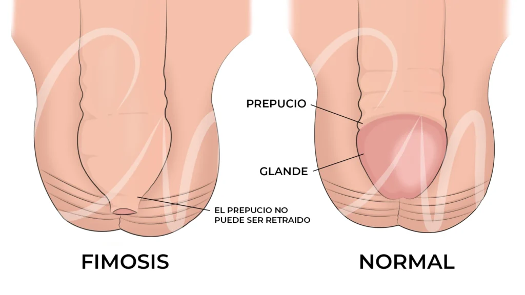 como saber si tengo fimosis